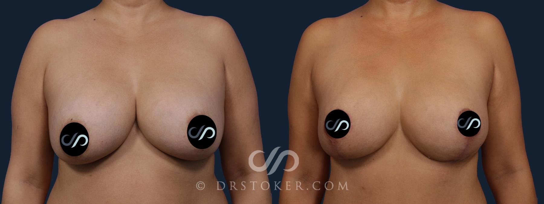 Before & After Breast Implant Correction Case 2076 Front View in Los Angeles, CA