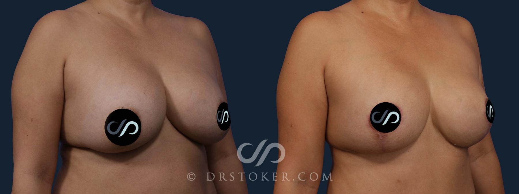 Before & After Breast Implant Correction Case 2076 Right Oblique View in Los Angeles, CA