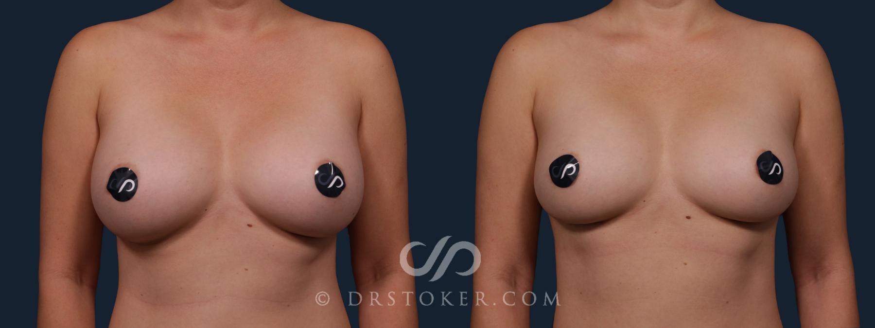 Before & After Breast Implant Correction Case 2152 Front View in Los Angeles, CA