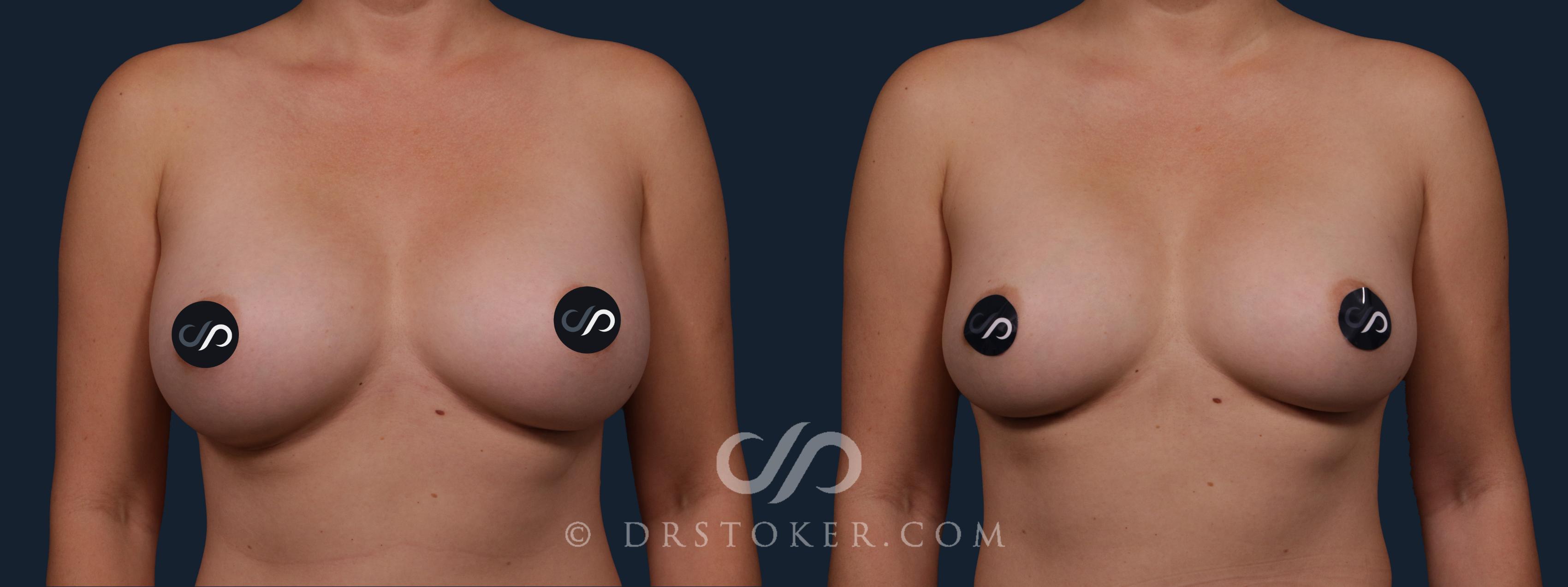 Before & After Breast Implant Correction Case 2166 Front View in Los Angeles, CA