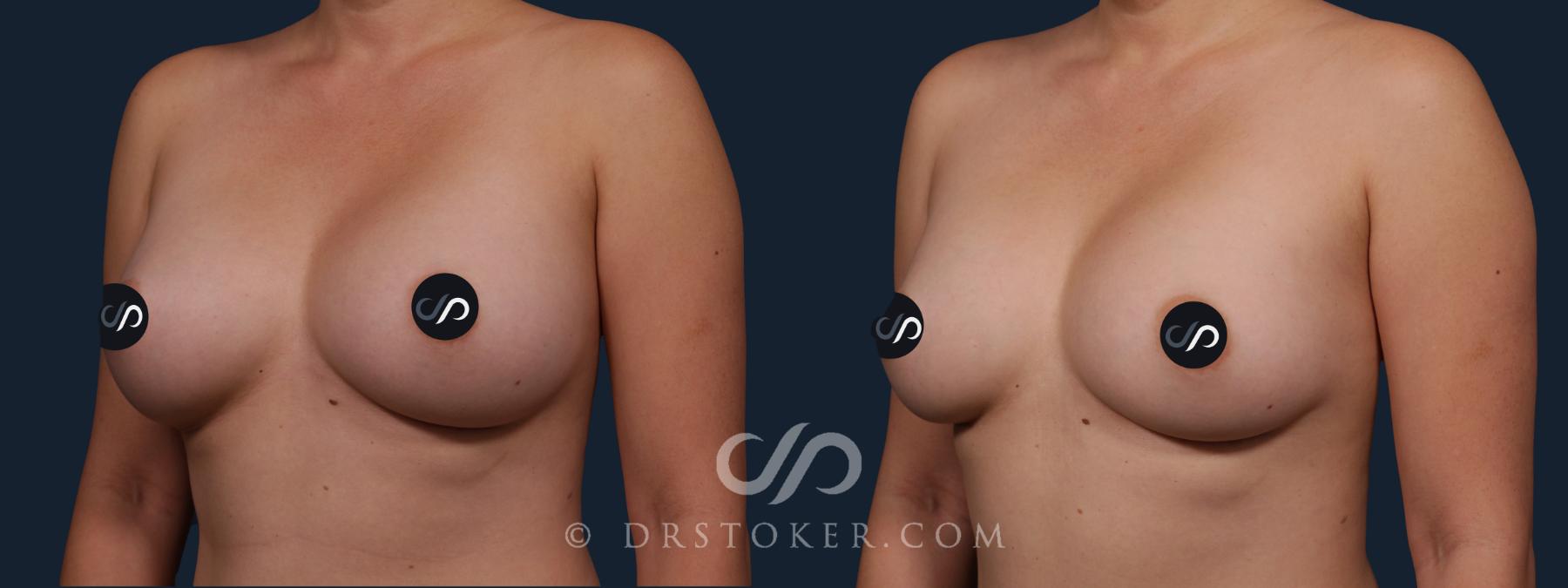 Before & After Breast Implant Correction Case 2166 Left Oblique View in Los Angeles, CA