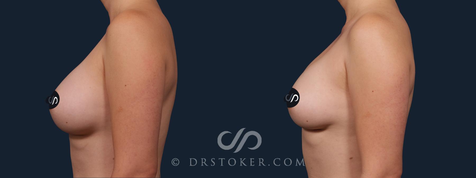 Before & After Breast Implant Correction Case 2166 Left Side View in Los Angeles, CA