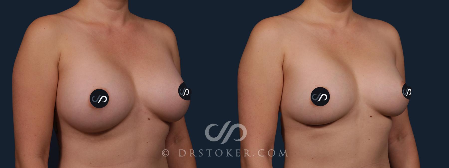 Before & After Breast Implant Correction Case 2166 Right Oblique View in Los Angeles, CA