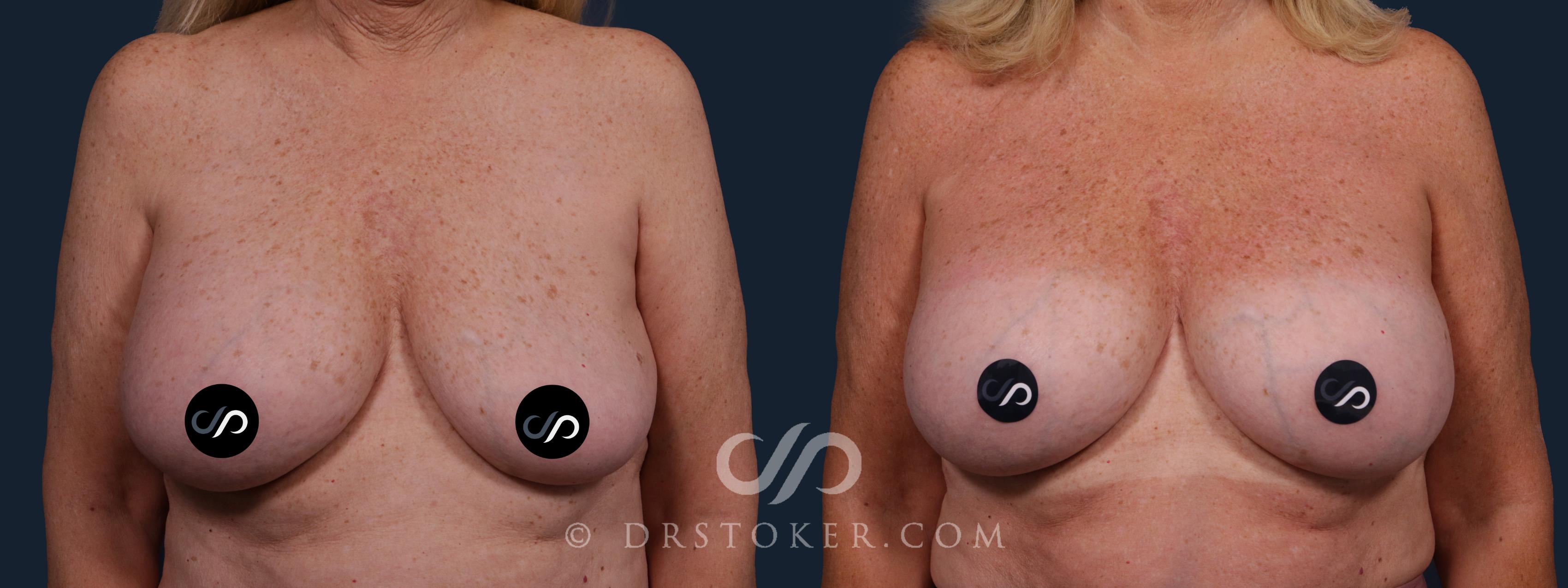 Before & After Breast Implant Correction Case 2186 Front View in Los Angeles, CA