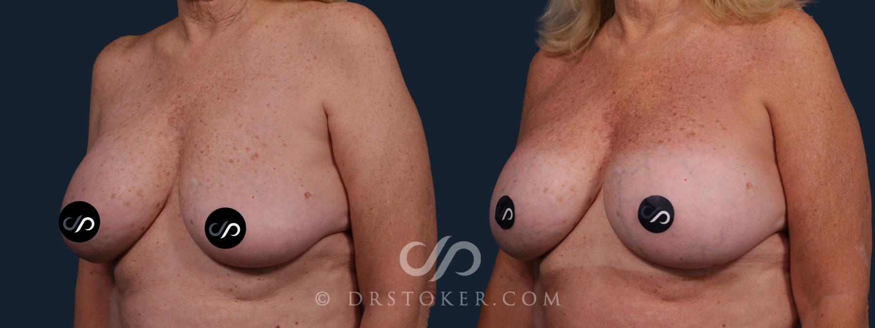 Before & After Breast Implant Correction Case 2186 Left Oblique View in Los Angeles, CA
