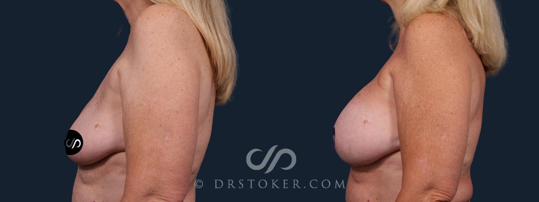 Before & After Breast Implant Correction Case 2186 Left Side View in Los Angeles, CA
