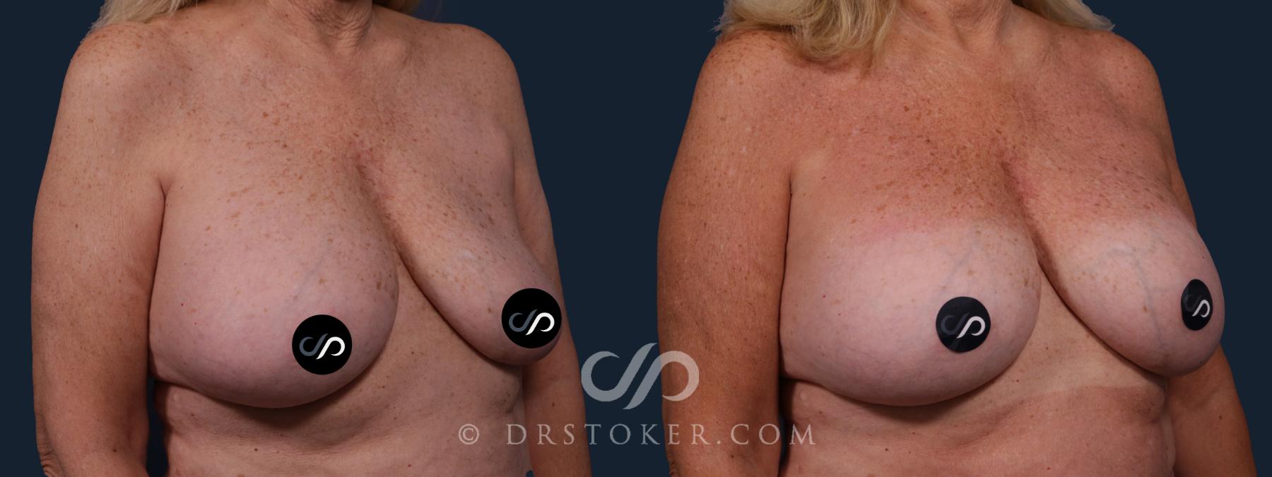 Before & After Breast Implant Correction Case 2186 Right Oblique View in Los Angeles, CA