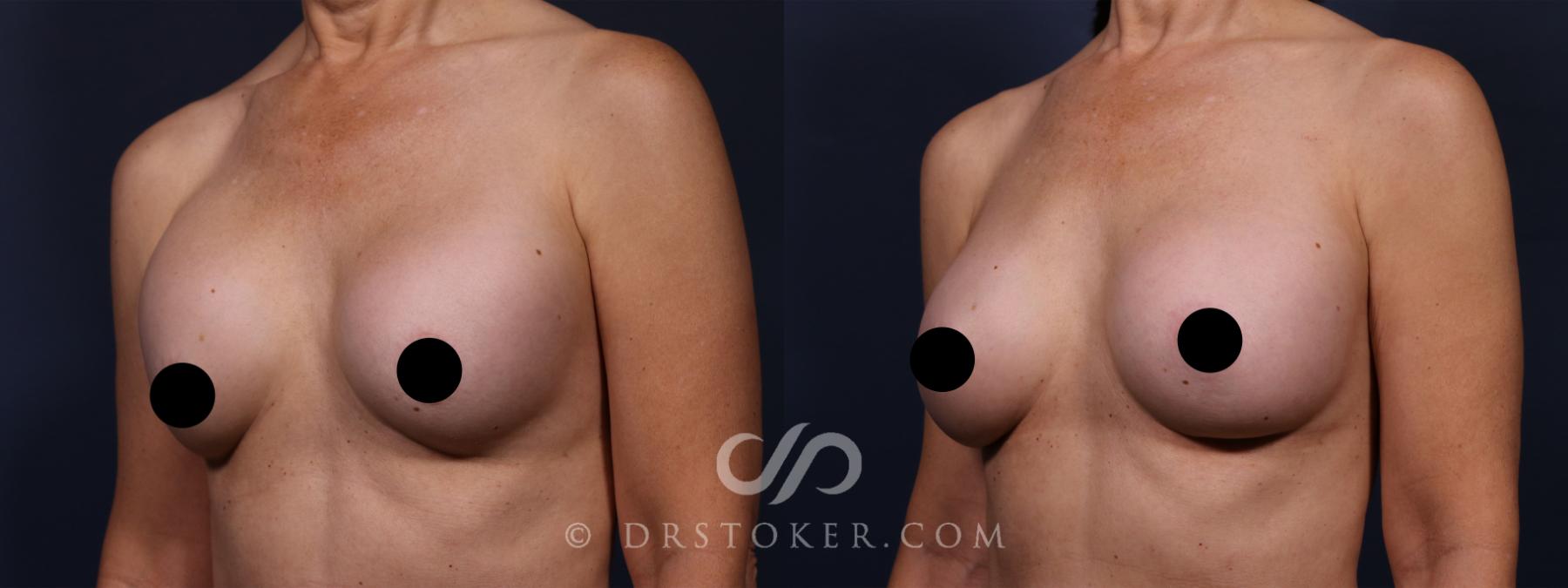 Before & After Breast Implant Correction Case 2595 Left Oblique View in Los Angeles, CA
