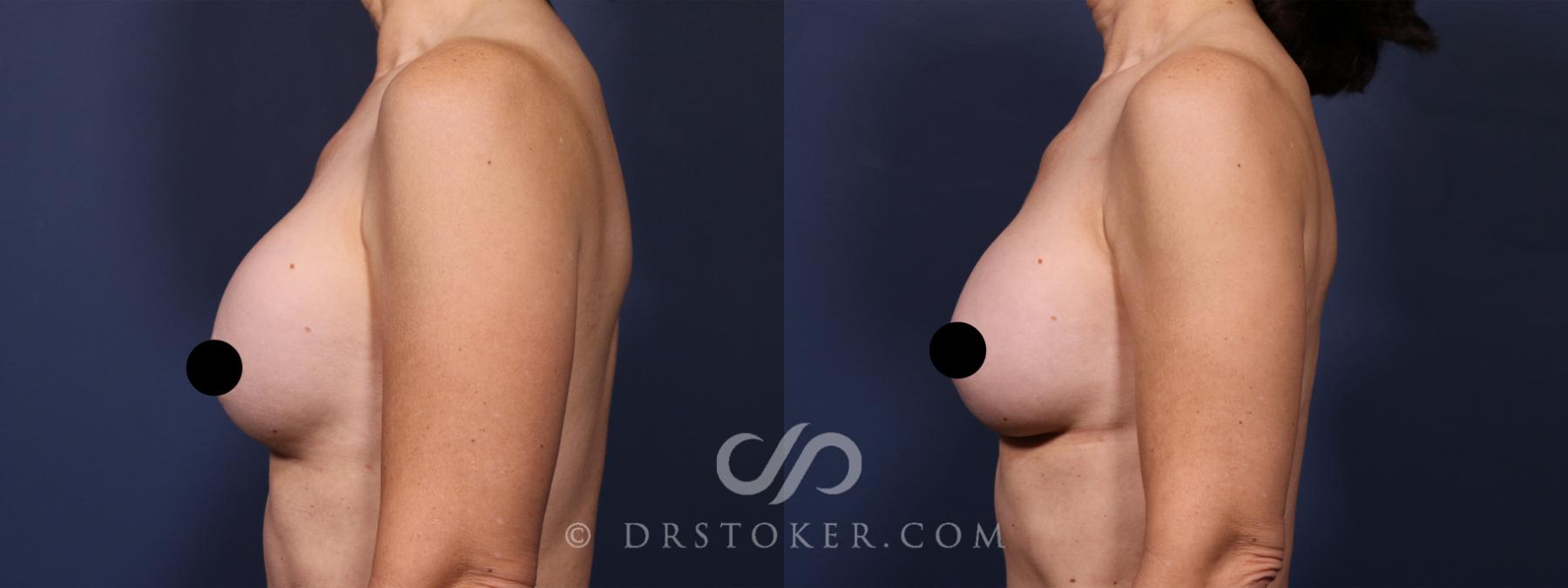 Before & After Breast Implant Correction Case 2595 Left Side View in Los Angeles, CA