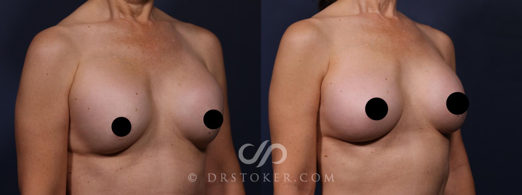 Before & After Breast Implant Correction Case 2595 Right Oblique View in Los Angeles, CA
