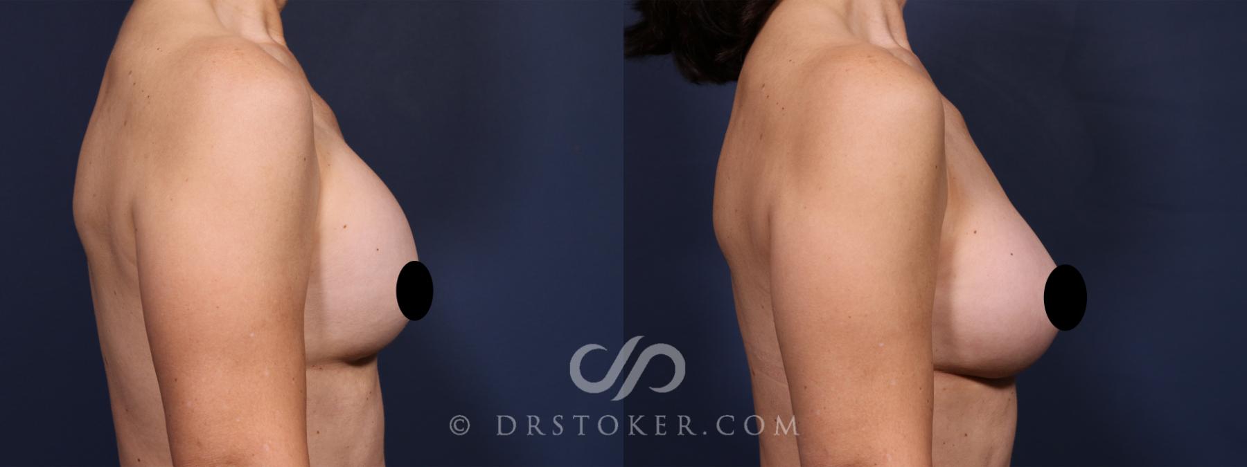 Before & After Breast Implant Correction Case 2595 Right Side View in Los Angeles, CA
