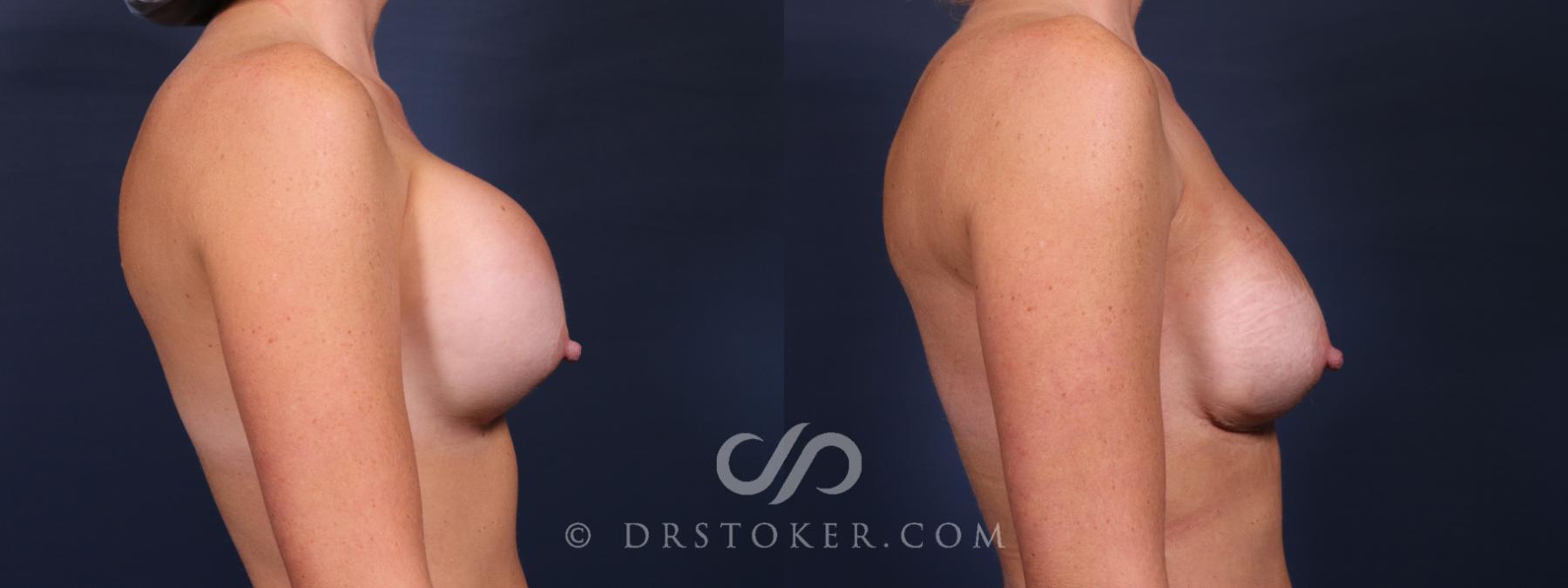 Before & After Breast Implant Correction Case 2596 Right Side View in Los Angeles, CA