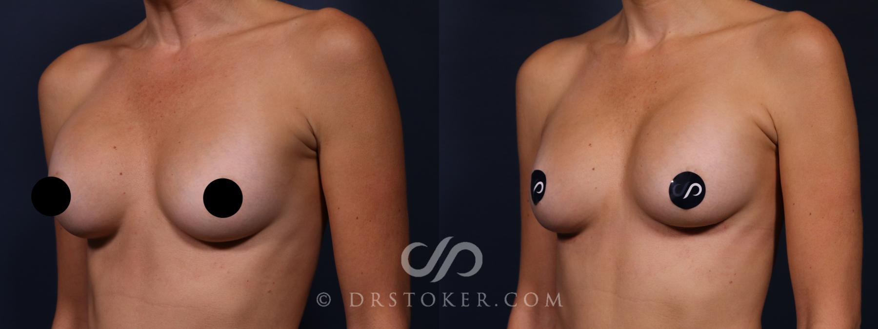 Before & After Breast Implant Correction Case 2631 Left Oblique View in Los Angeles, CA