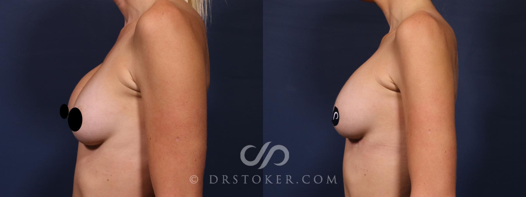 Before & After Breast Implant Correction Case 2631 Left Side View in Los Angeles, CA