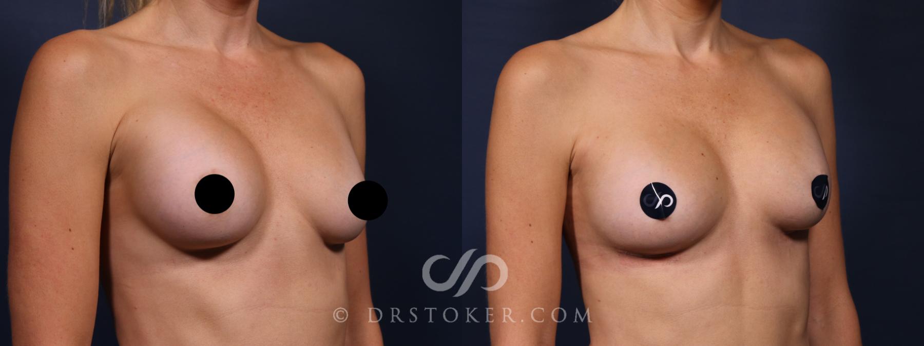 Before & After Breast Implant Correction Case 2631 Right Oblique View in Los Angeles, CA