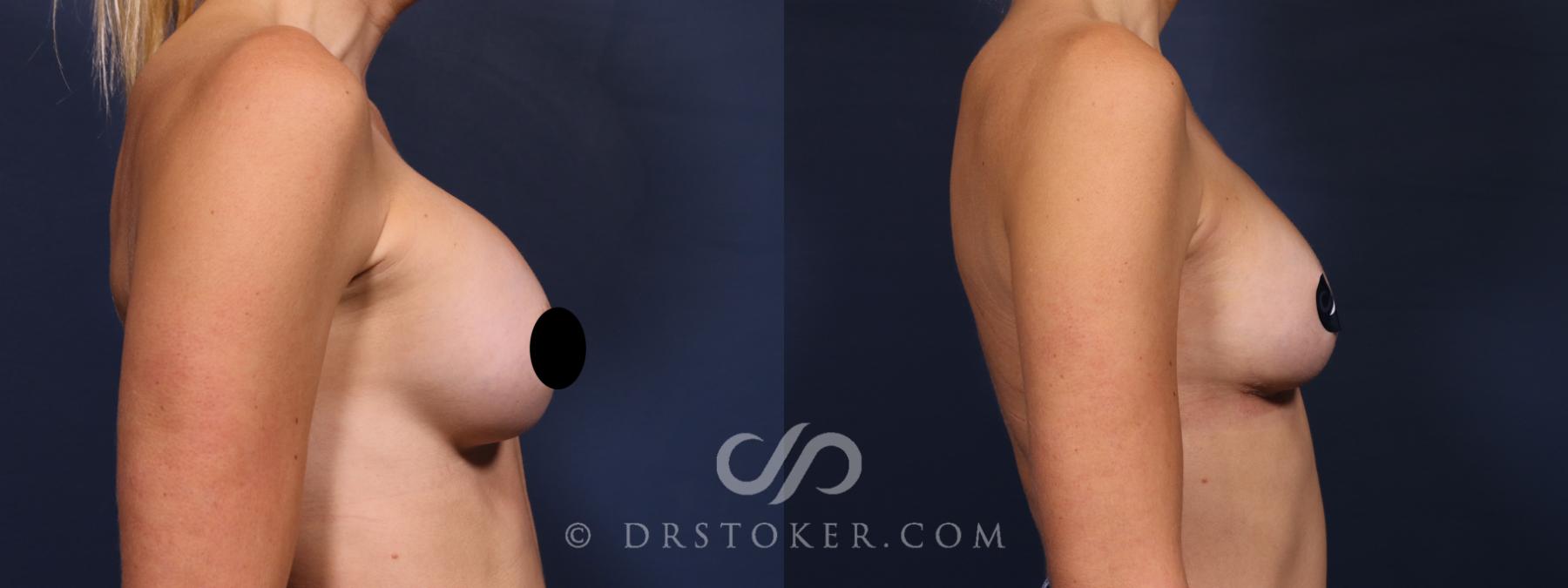 Before & After Breast Implant Correction Case 2631 Right Side View in Los Angeles, CA