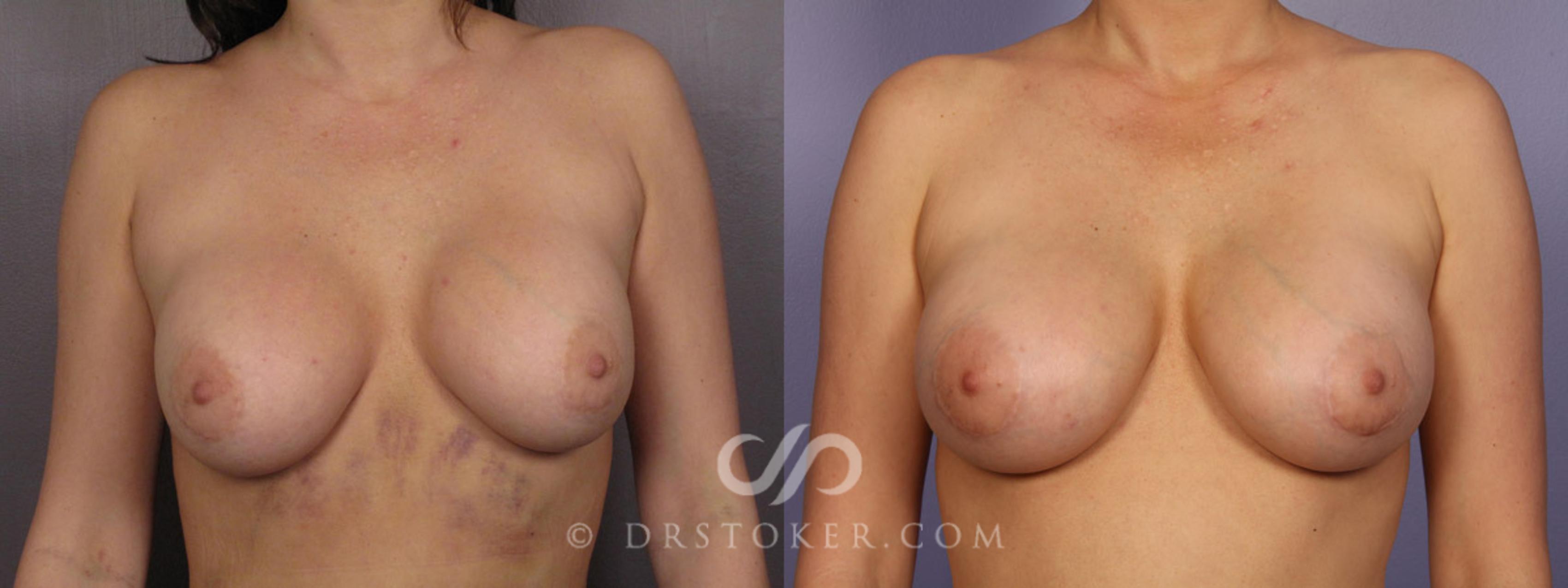 Before & After Breast Implant Correction Case 283 View #1 View in Los Angeles, CA