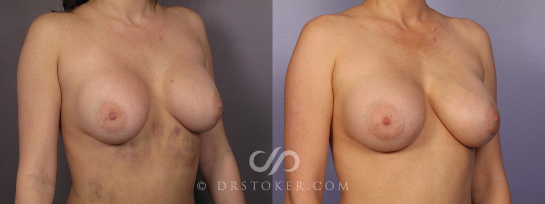 Before & After Breast Implant Correction Case 283 View #2 View in Los Angeles, CA