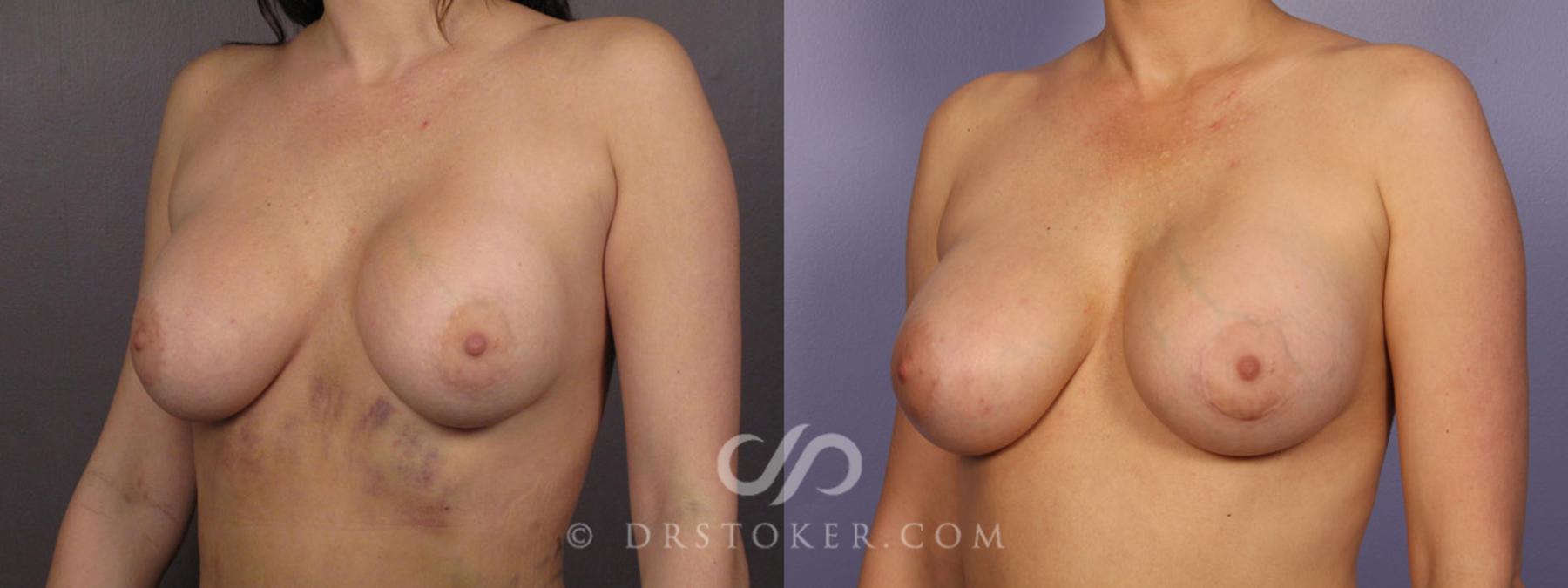 Before & After Breast Implant Correction Case 283 View #3 View in Los Angeles, CA