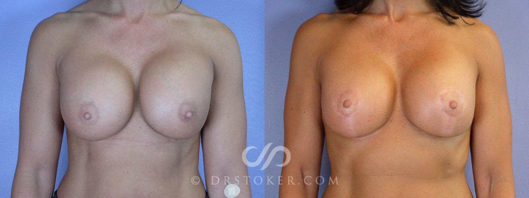 Before & After Breast Lift Case 341 View #1 View in Los Angeles, CA
