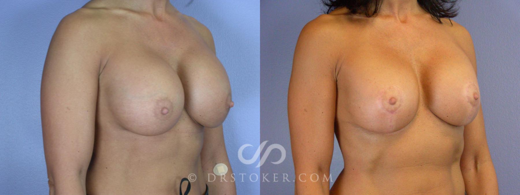 Before & After Breast Lift Case 341 View #2 View in Los Angeles, CA