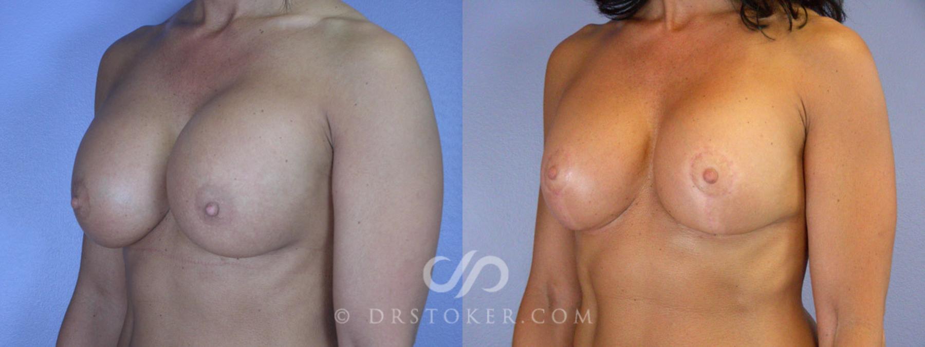 Before & After Breast Implant Correction Case 341 View #3 View in Los Angeles, CA