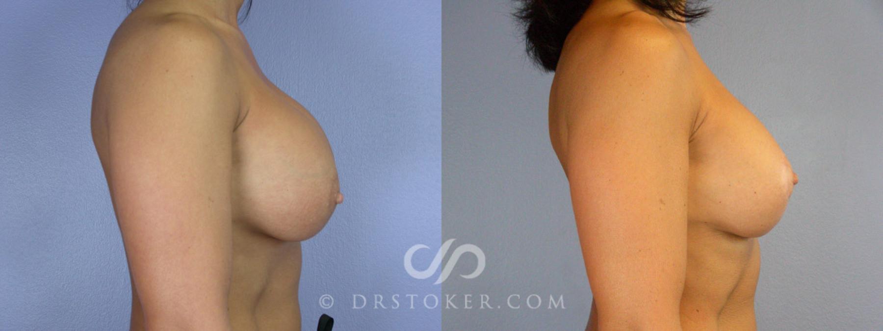 Before & After Breast Implant Correction Case 341 View #4 View in Los Angeles, CA