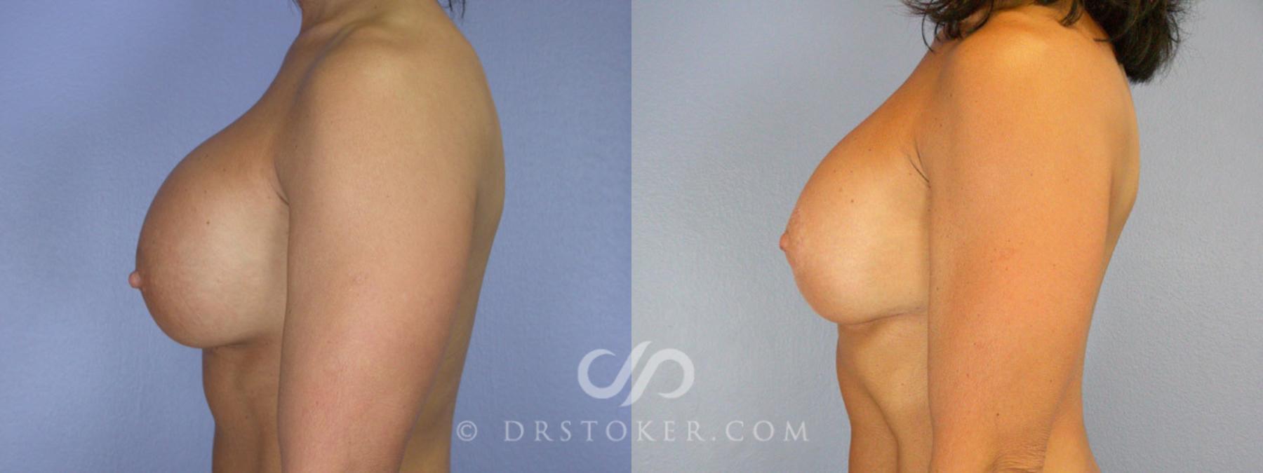 Before & After Breast Lift Case 341 View #5 View in Los Angeles, CA