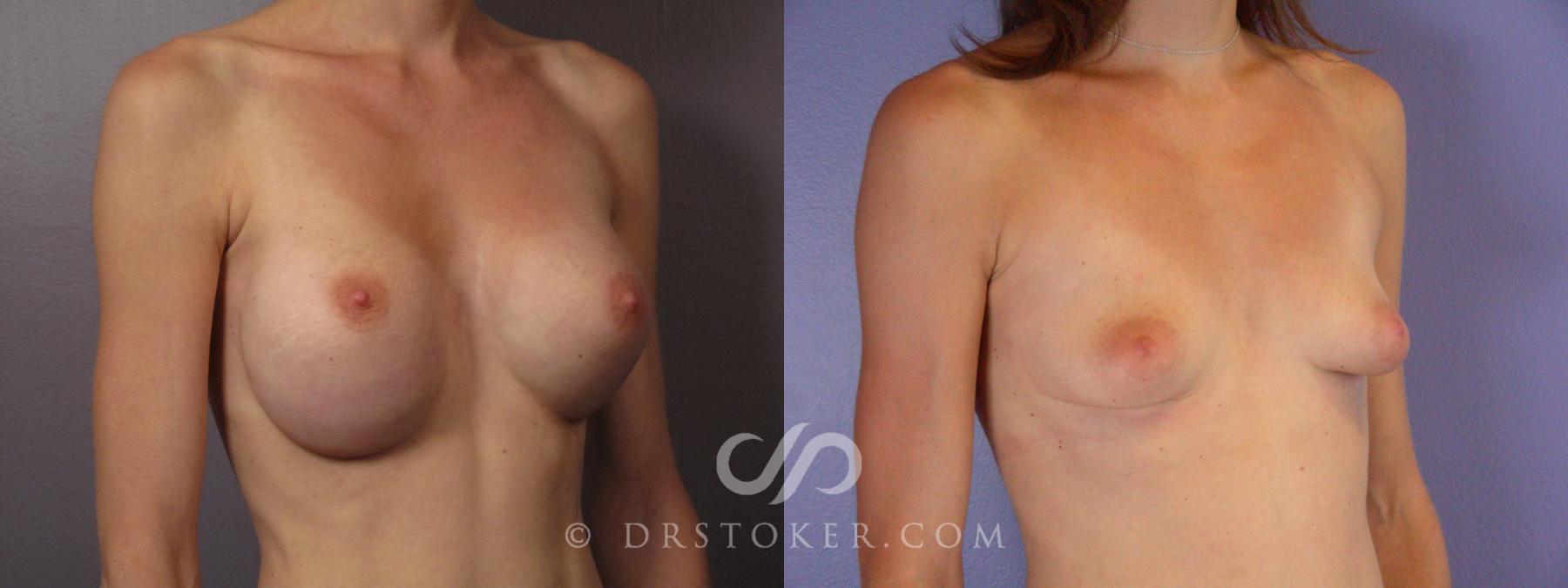 Before & After Breast Implant Removal Case 377 View #2 View in Los Angeles, CA