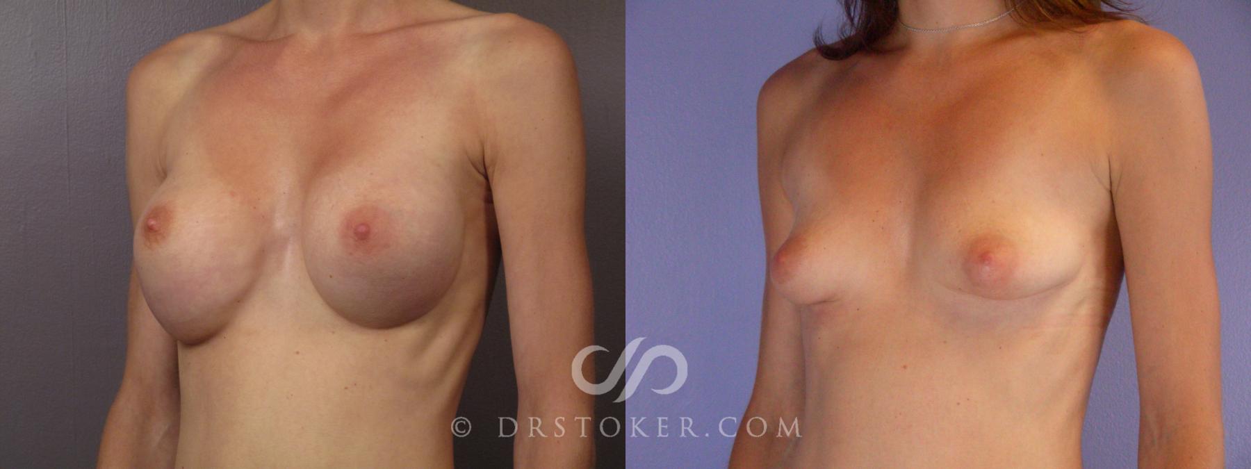 Before & After Breast Implant Correction Case 377 View #3 View in Los Angeles, CA