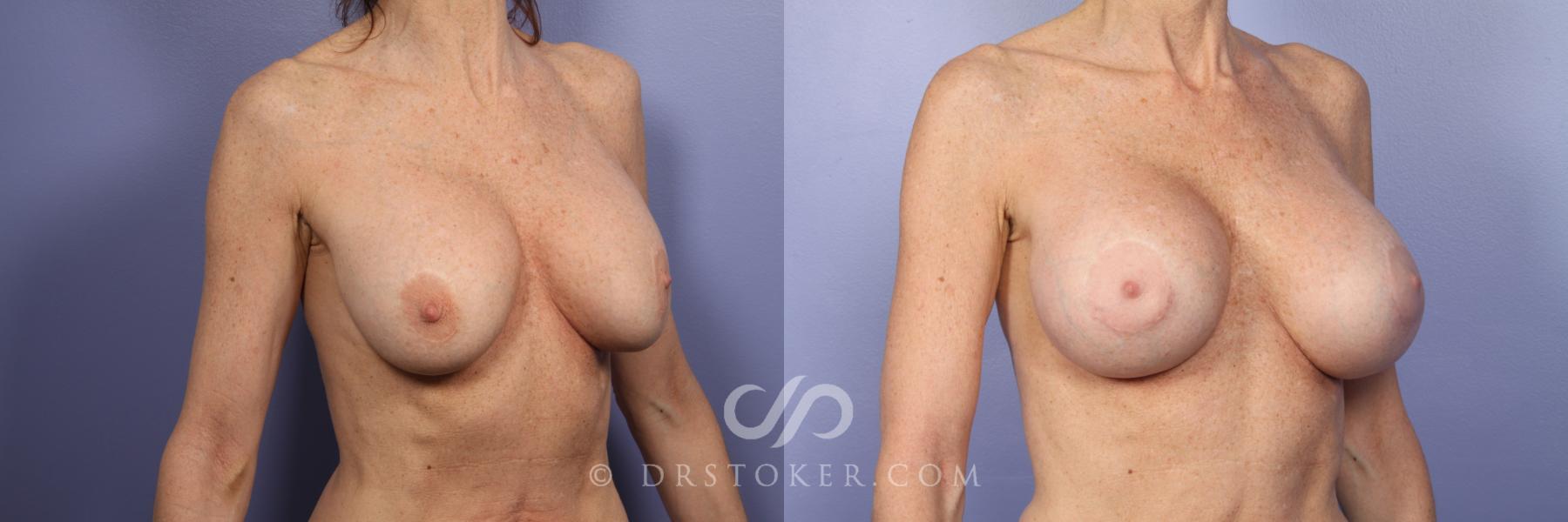 Before & After Breast Implant Correction Case 386 View #2 View in Los Angeles, CA