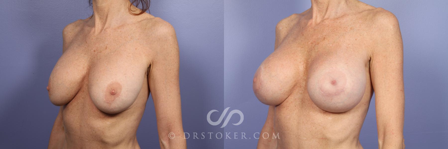Before & After Breast Implant Correction Case 386 View #3 View in Los Angeles, CA