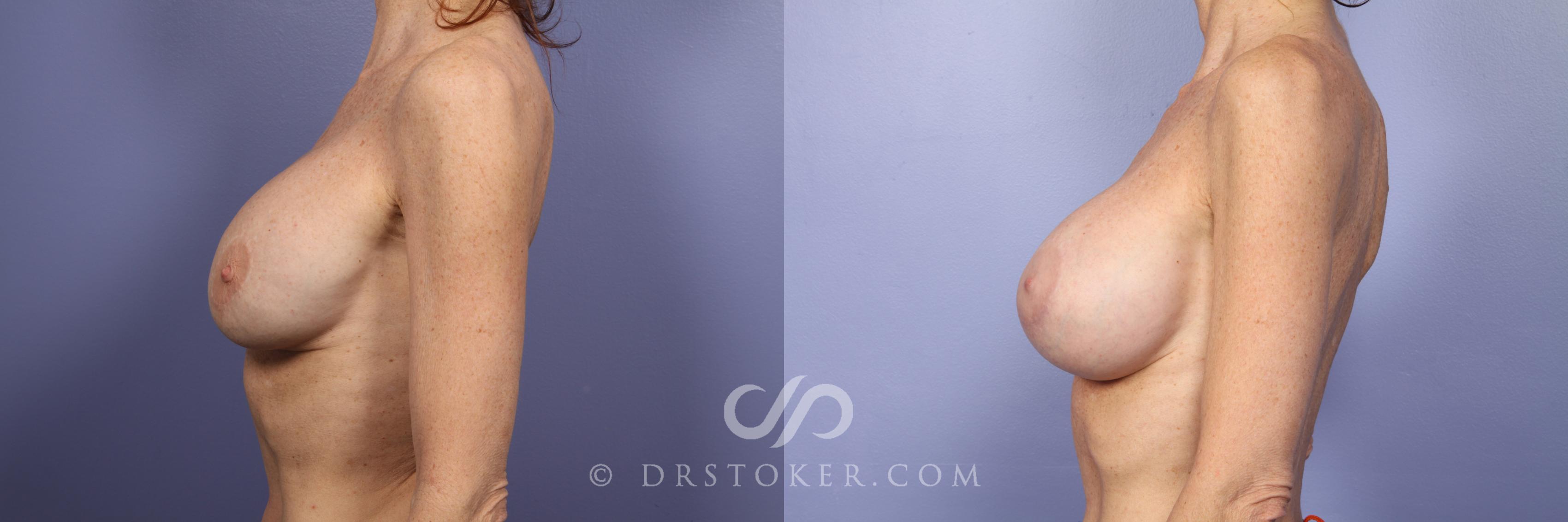 Before & After Breast Implant Correction Case 386 View #4 View in Los Angeles, CA