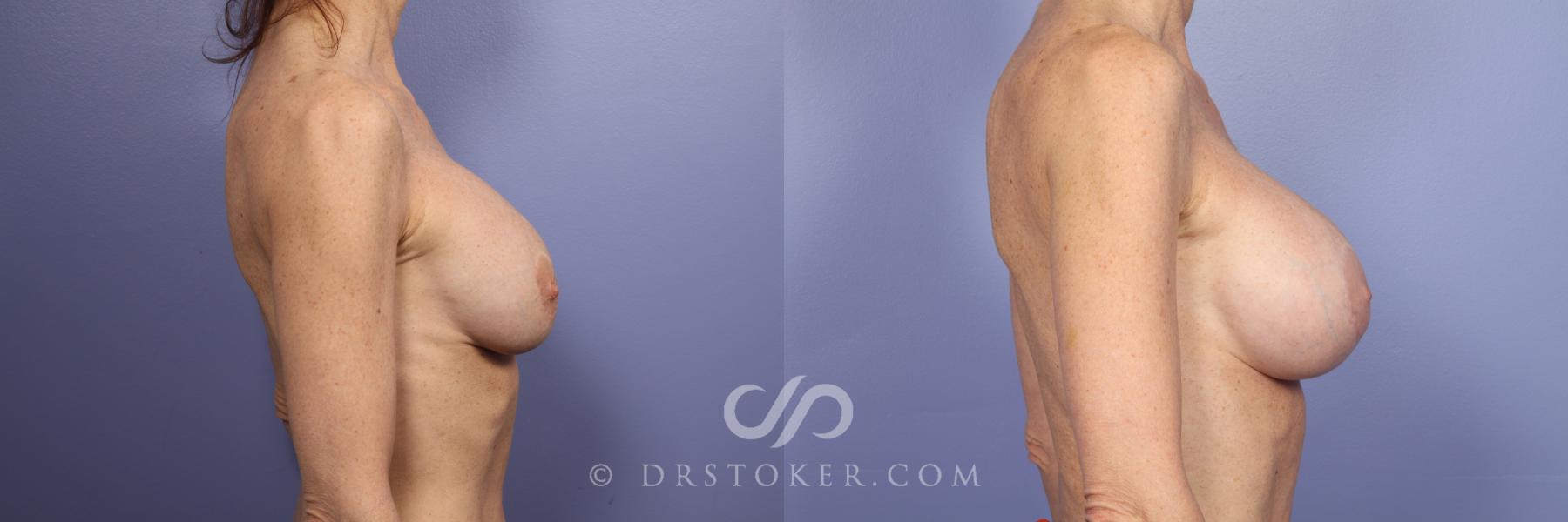 Before & After Breast Asymmetry Correction Case 386 View #5 View in Los Angeles, CA