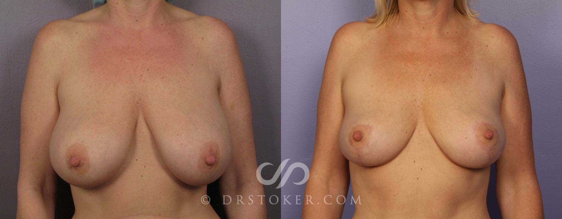 Before & After Breast Lift Case 388 View #1 View in Los Angeles, CA