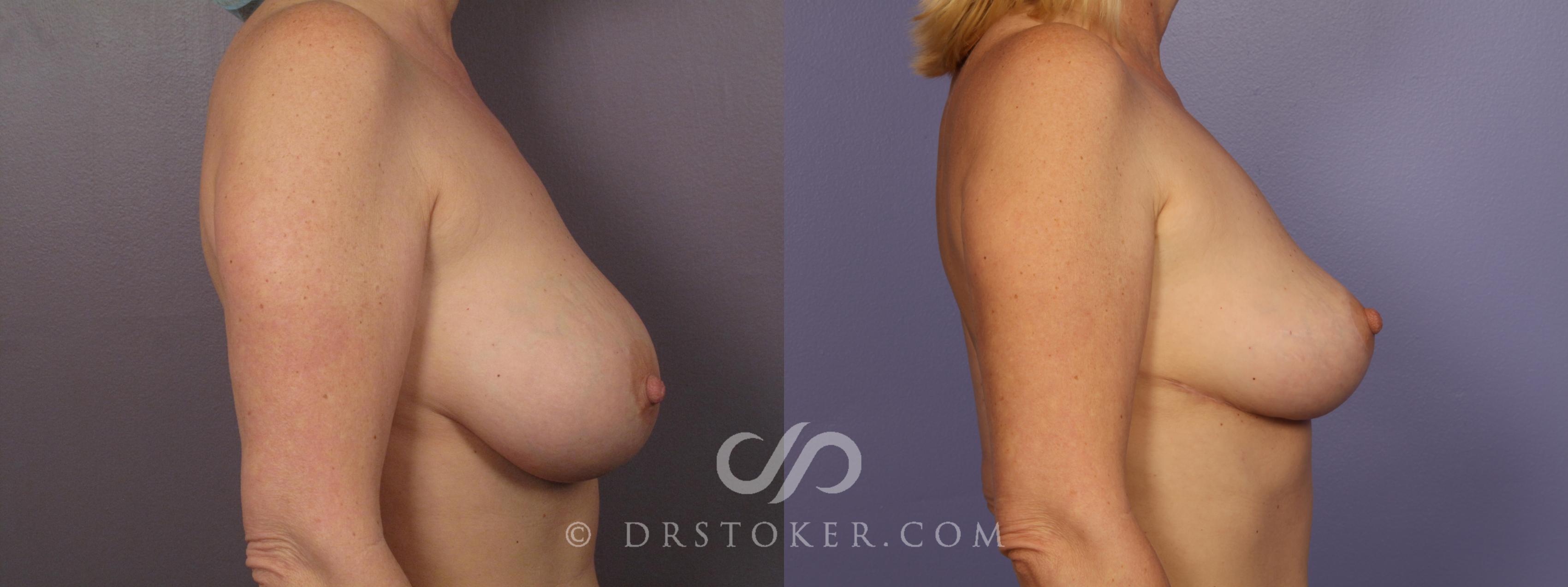 Before & After Breast Implant Correction Case 388 View #5 View in Los Angeles, CA