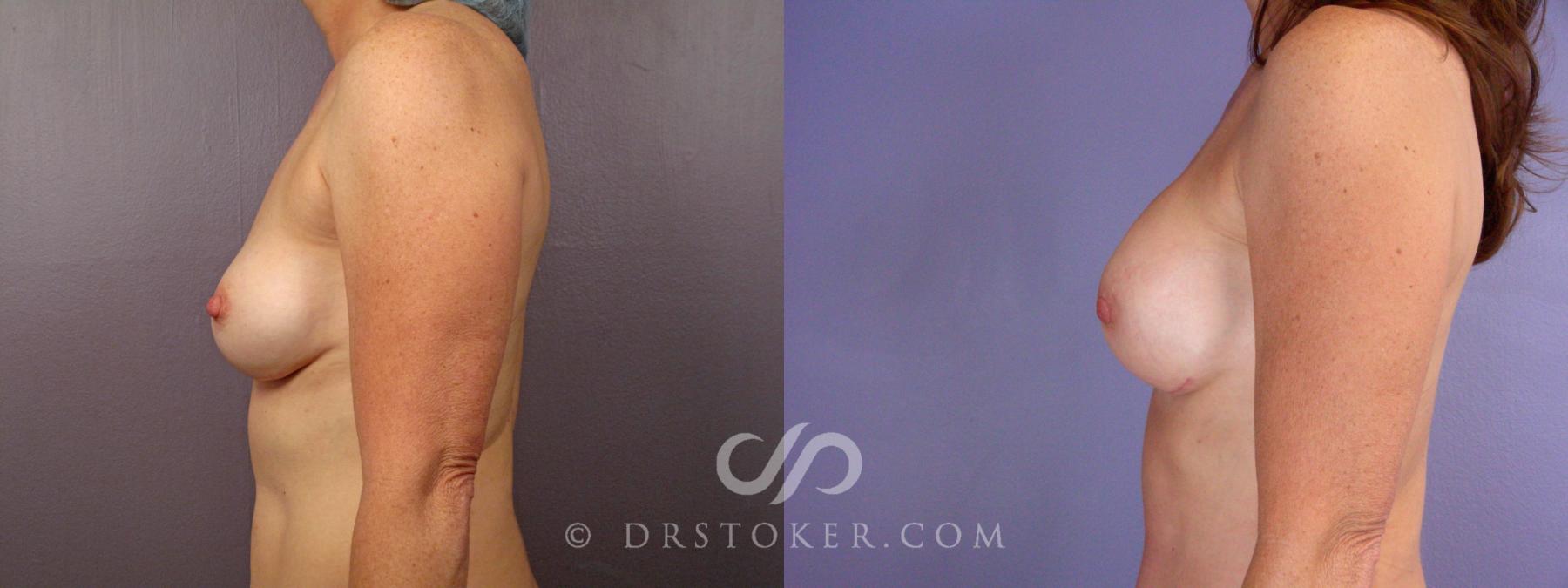 Before & After Breast Implant Correction Case 503 View #5 View in Los Angeles, CA