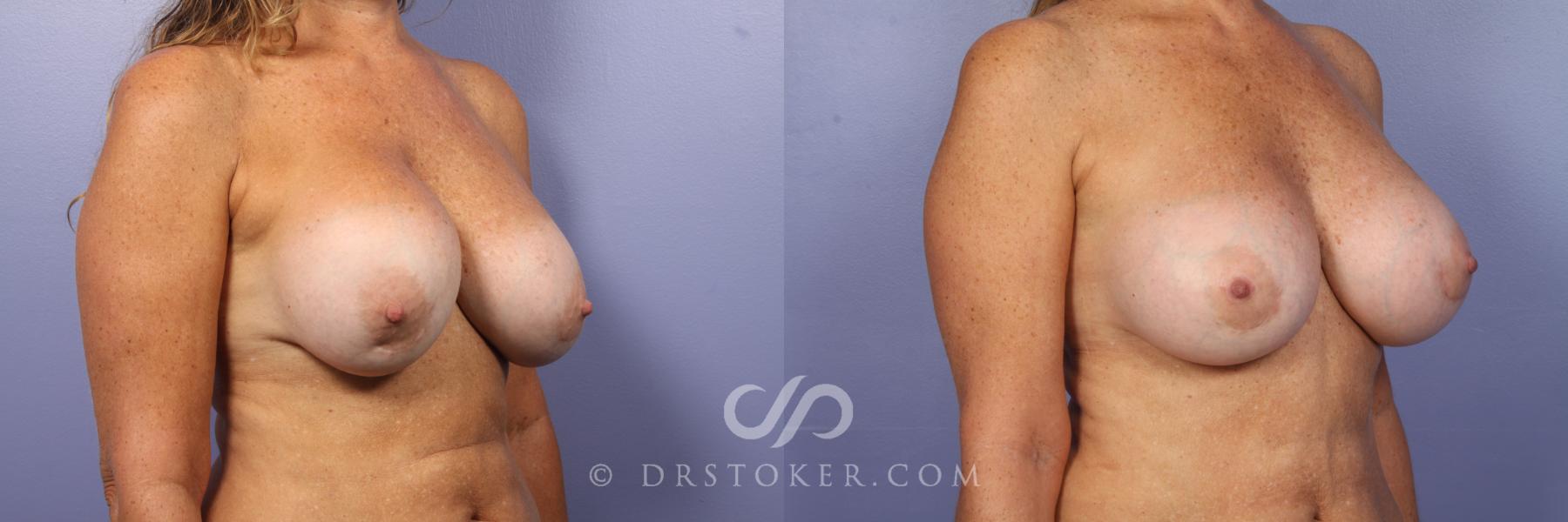 Before & After Breast Implant Correction Case 504 View #2 View in Los Angeles, CA