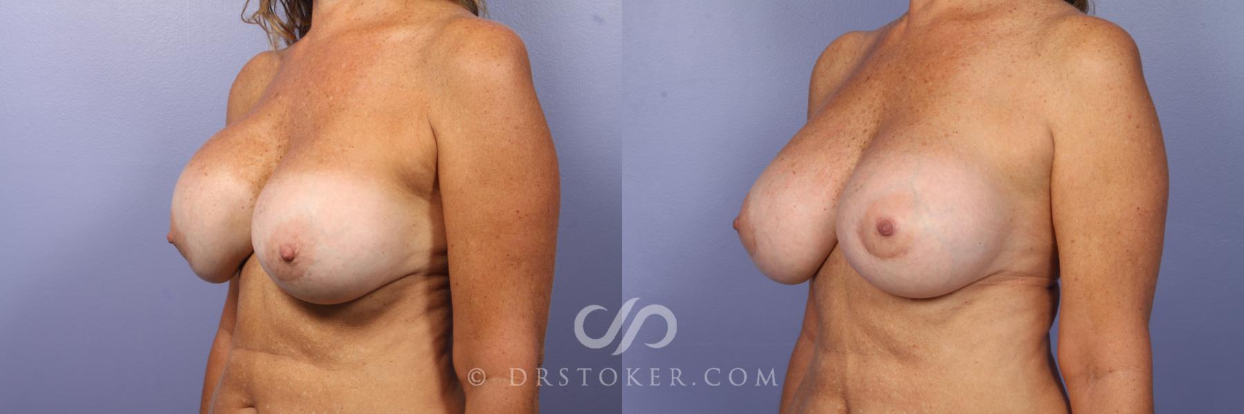 Before & After Breast Implant Correction Case 504 View #4 View in Los Angeles, CA