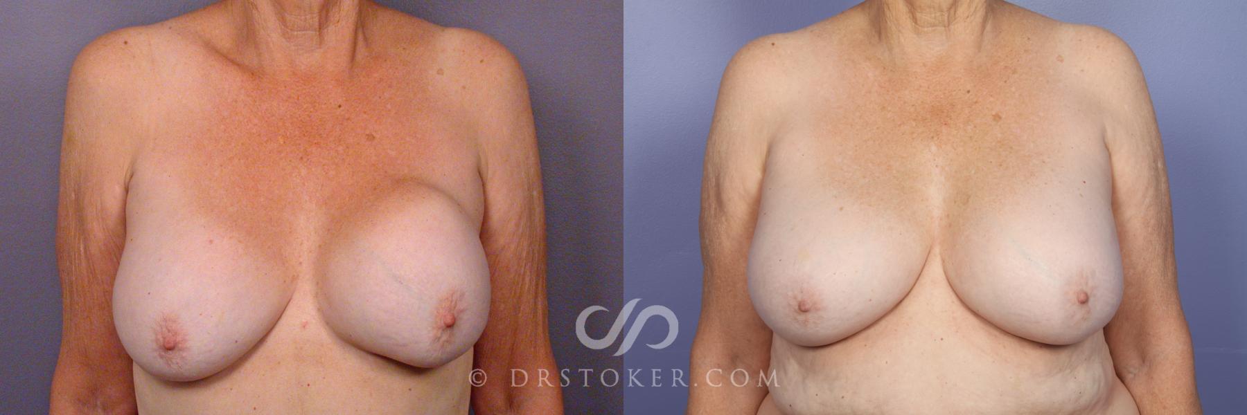 Before & After Breast Implant Correction Case 505 View #1 View in Los Angeles, CA
