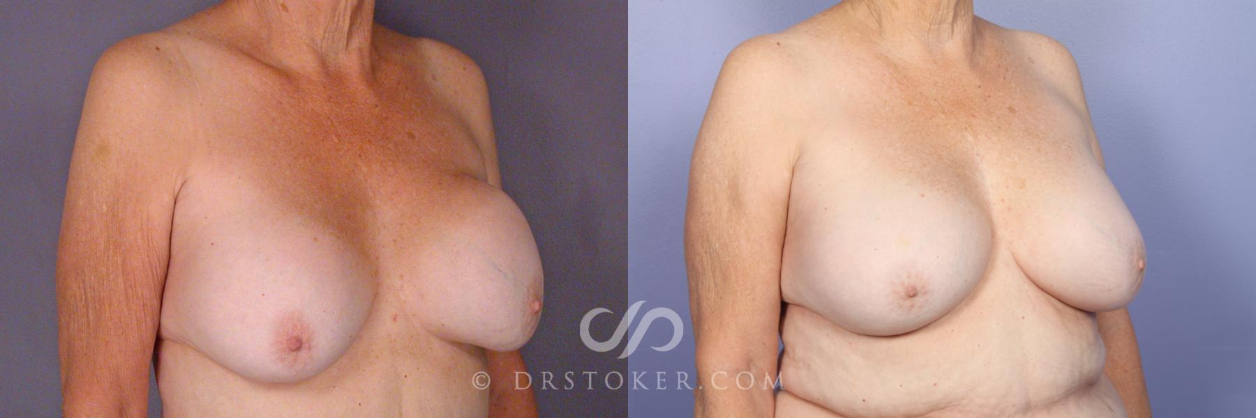 Before & After Breast Implant Correction Case 505 View #2 View in Los Angeles, CA