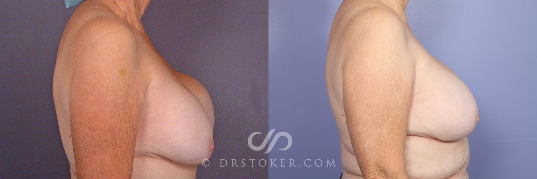 Before & After Breast Implant Correction Case 505 View #3 View in Los Angeles, CA