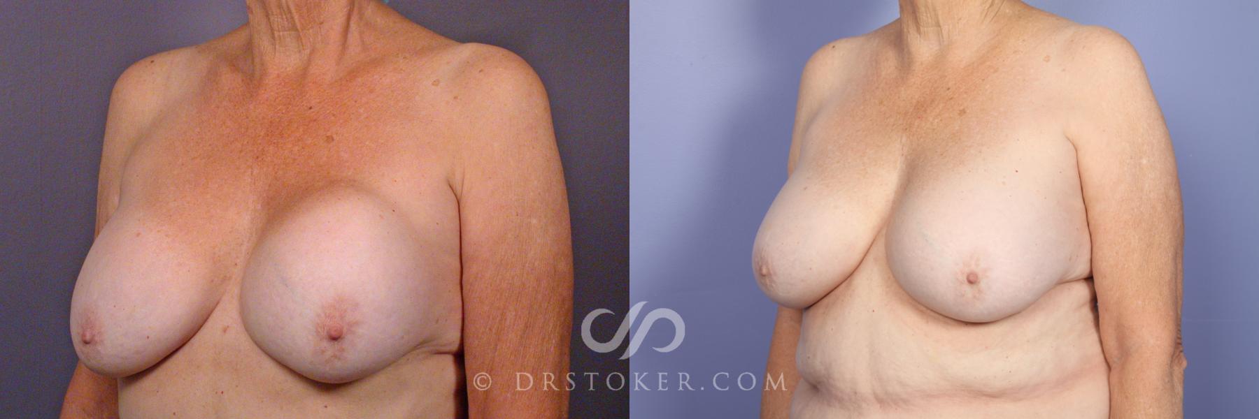 Before & After Breast Implant Correction Case 505 View #4 View in Los Angeles, CA