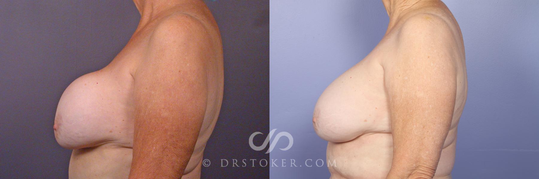 Before & After Breast Implant Correction Case 505 View #5 View in Los Angeles, CA