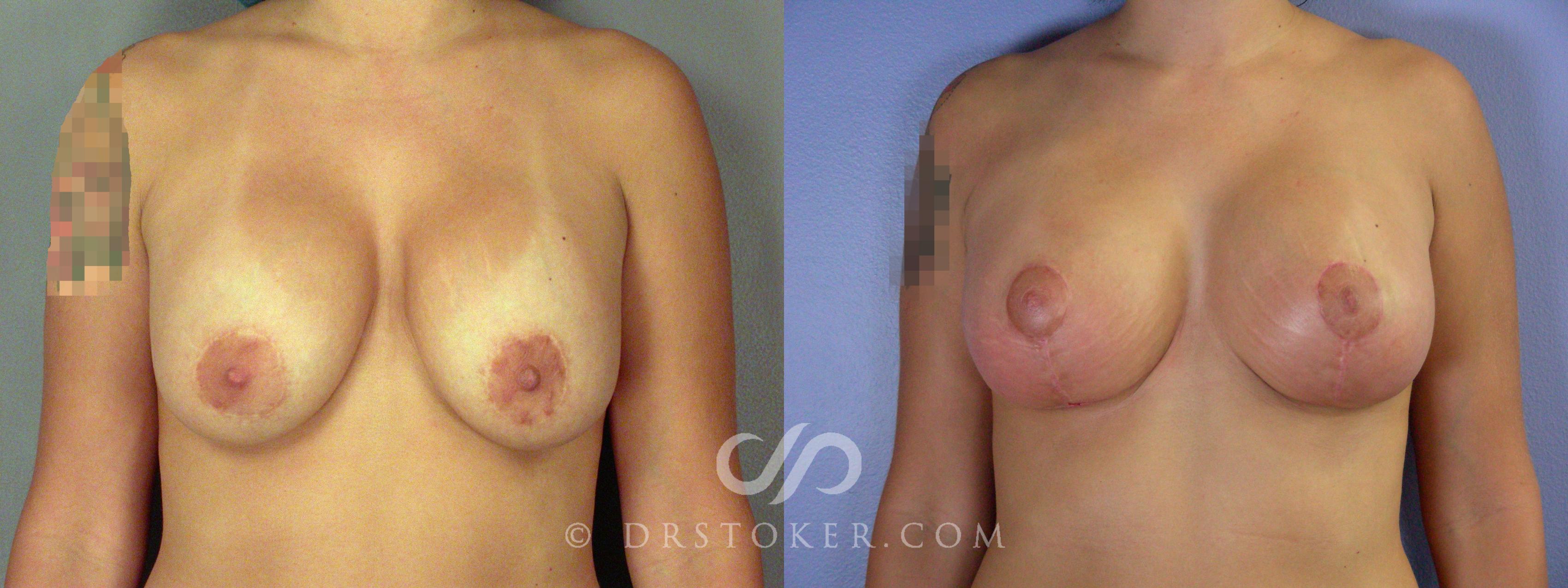 Before & After Breast Implant Correction Case 507 View #1 View in Marina del Rey, CA