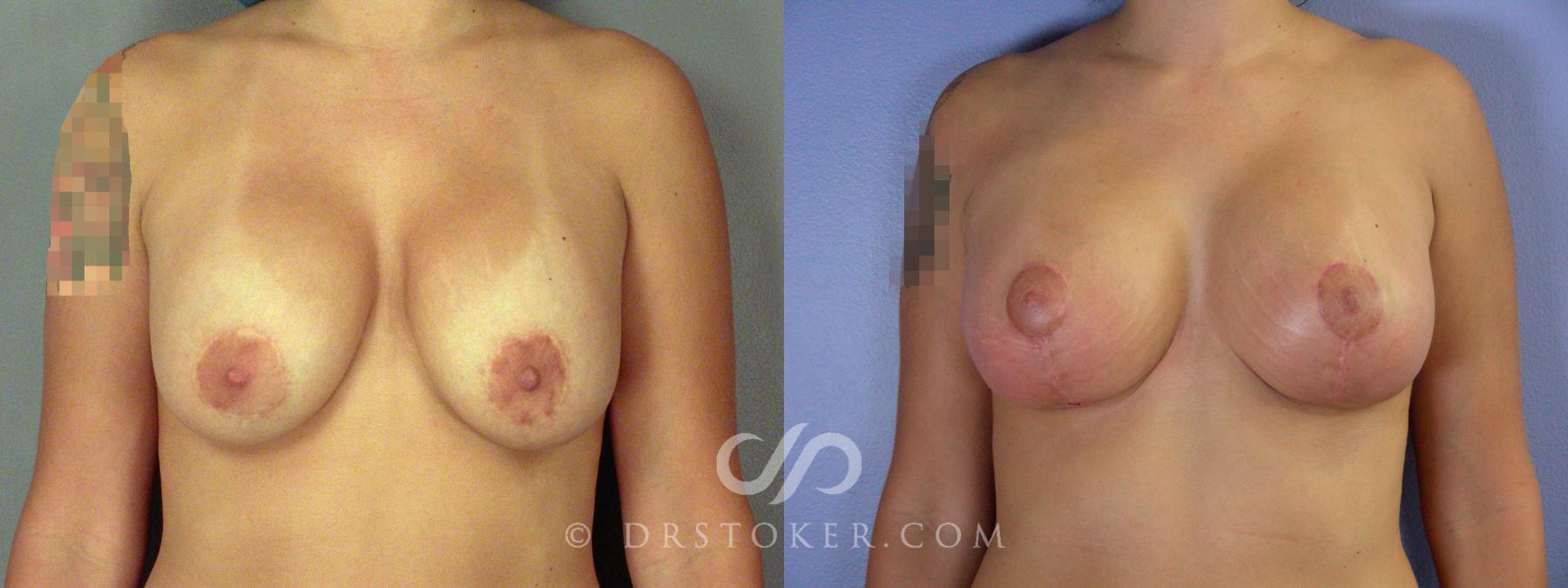 Before & After Breast Implant Correction Case 507 View #1 View in Los Angeles, CA
