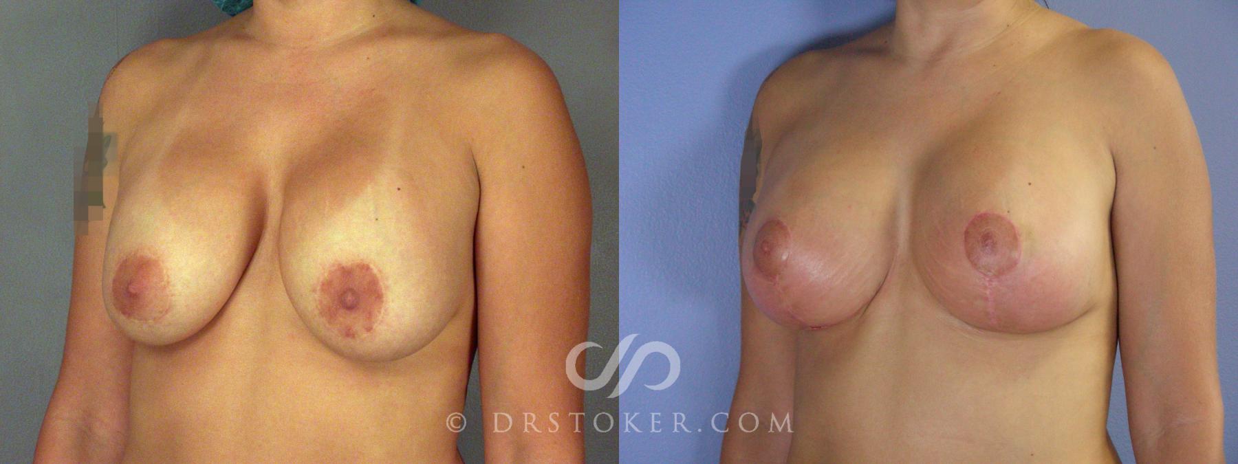 Before & After Breast Implant Correction Case 507 View #2 View in Los Angeles, CA
