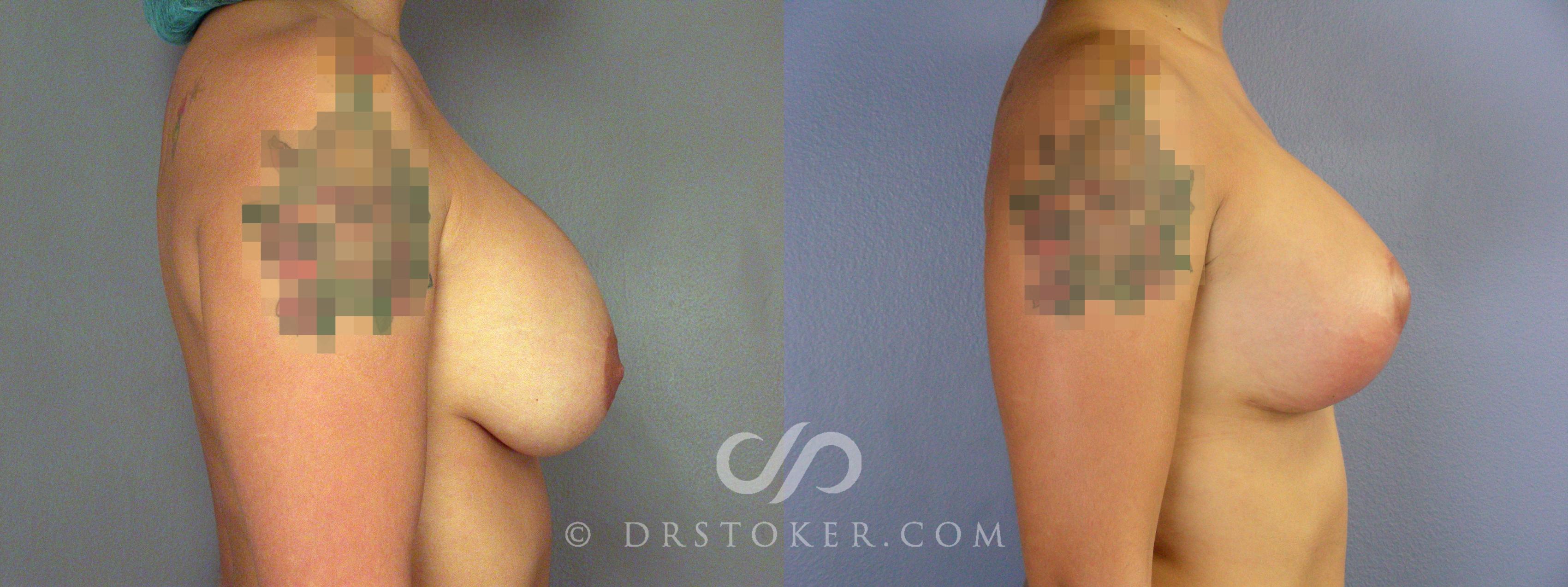 Before & After Breast Implant Correction Case 507 View #3 View in Los Angeles, CA