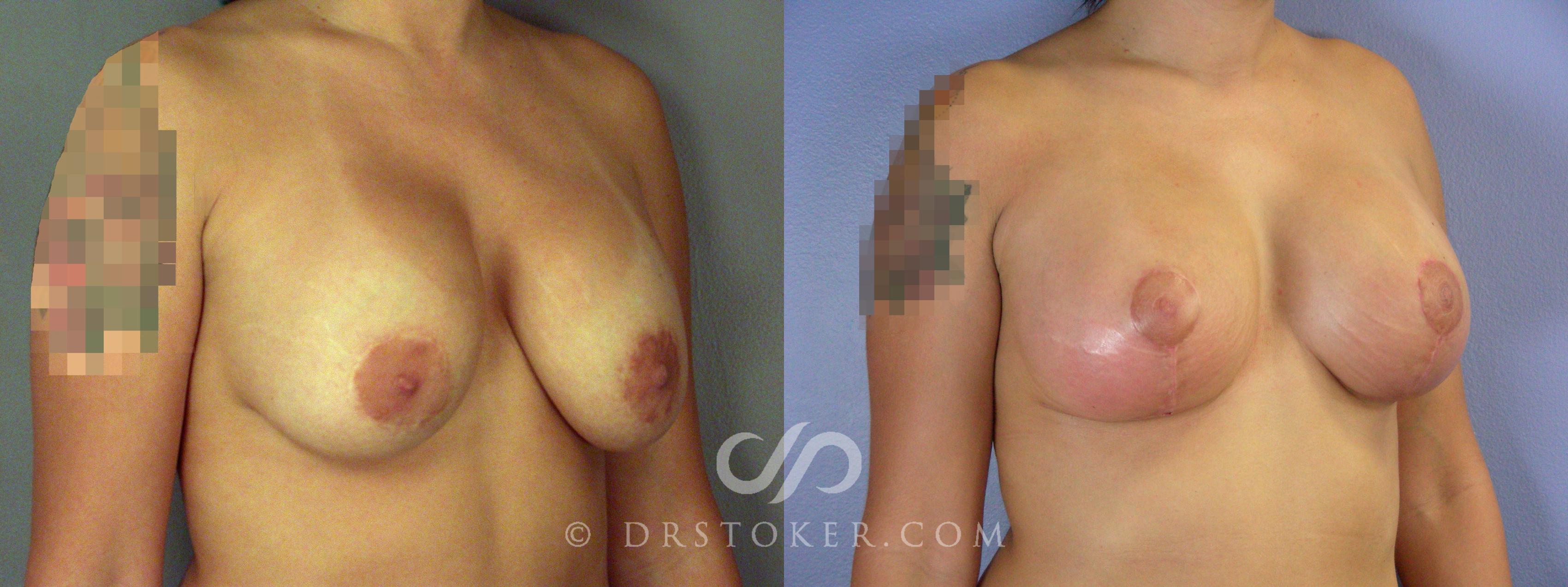 Before & After Breast Implant Correction Case 507 View #5 View in Los Angeles, CA