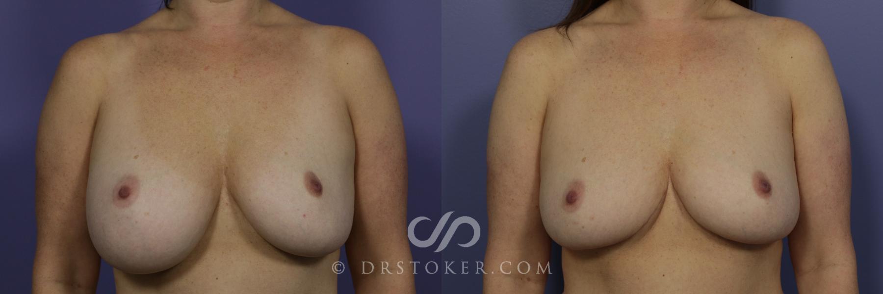 Before & After Breast Implant Correction Case 958 View #1 View in Los Angeles, CA